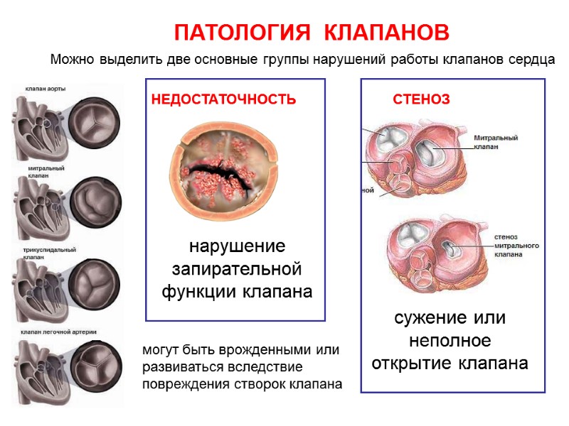 ПАТОЛОГИЯ  КЛАПАНОВ Можно выделить две основные группы нарушений работы клапанов сердца НЕДОСТАТОЧНОСТЬ СТЕНОЗ